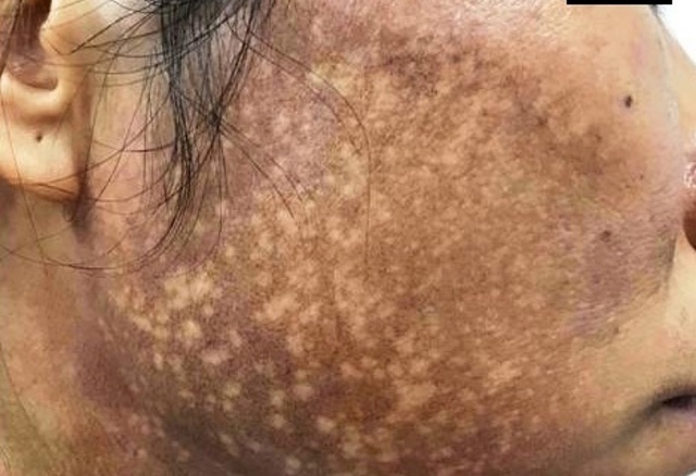 Da mặt như “bánh đa vừng đen” vì bôi kem trộn làm trắng - 1 Da mặt như “bánh đa vừng đen” vì bôi kem trộn làm trắng - 1