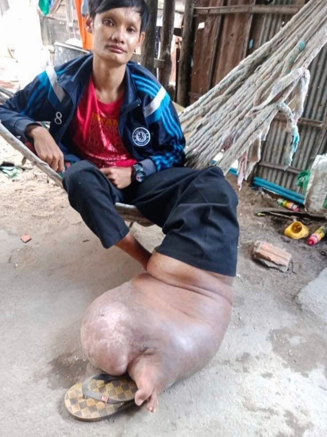 Bị muỗi đốt không điều trị, người đàn ông mang “bàn chân lợn” suốt 21 năm - 3 Bị muỗi đốt không điều trị, người đàn ông mang “bàn chân lợn” suốt 21 năm - 3