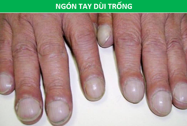 Cảnh giác với những dấu hiệu dễ bị nhầm lẫn của ung thư phổi - 3