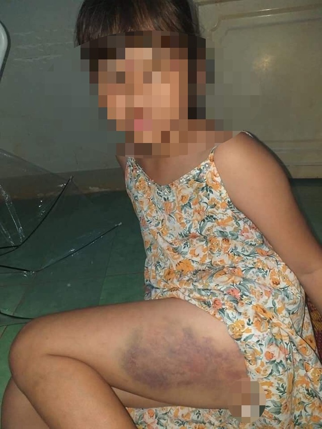 Đắk Lắk: Tạm đình chỉ cô giáo đánh bầm tím đùi học sinh lớp 3 - 1