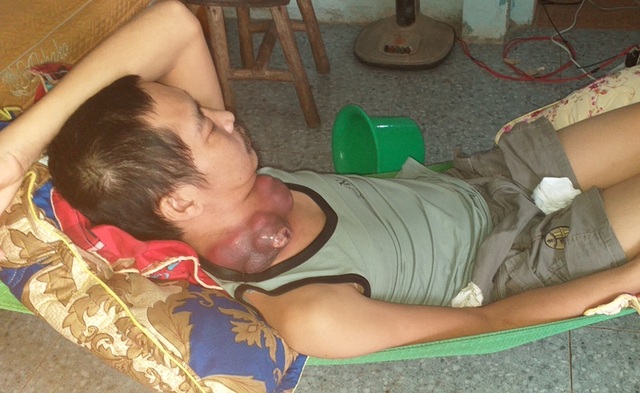 Người đàn ông nghèo đau đớn mang khối u như những chiếc bát úp vào cổ - 3 Người đàn ông nghèo đau đớn mang khối u như những chiếc bát úp vào cổ - 3