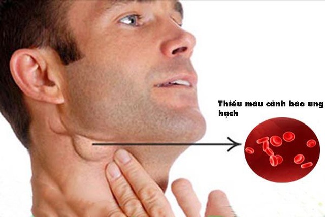 Những dấu hiệu cảnh báo ung thư hạch bạn cần chú ý - 1 Những dấu hiệu cảnh báo ung thư hạch bạn cần chú ý - 1