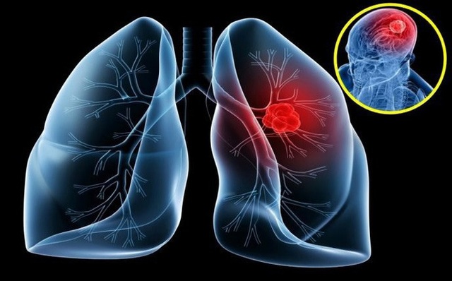 5 bệnh ung thư người Việt mắc nhiều nhất - 2 5 bệnh ung thư người Việt mắc nhiều nhất - 2
