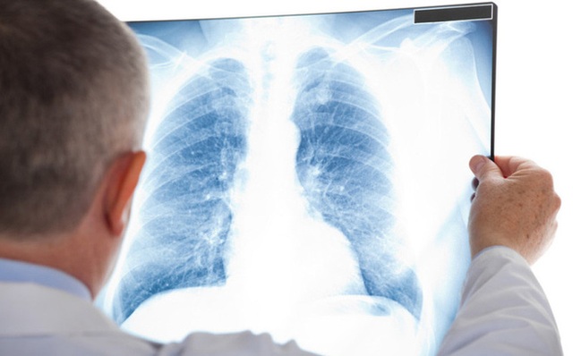 Ung thư phổi có phòng ngừa được không? - 1