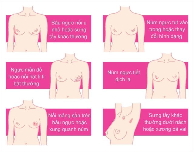 E ngại không đi khám, nhiều phụ nữ Việt phát hiện ung thư vú khi đã muộn - 2