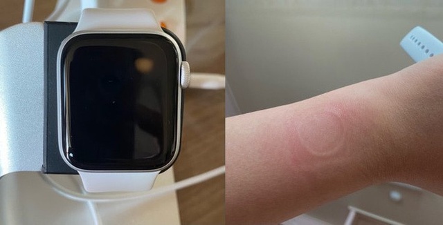 Đồng hồ “giá rẻ” Apple Watch SE khiến người dùng bị bỏng do quá tải nhiệt - 2
