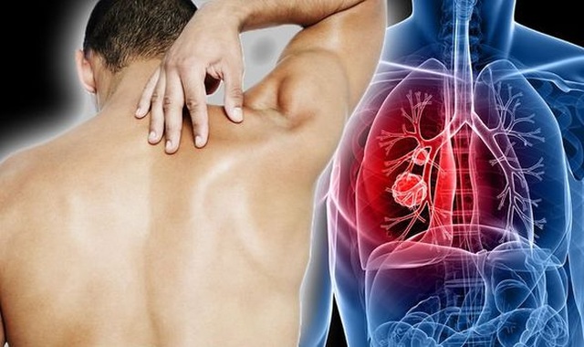 5 bệnh ung thư phổ biến nhất ở nam giới, phòng tránh như thế nào - 1 5 bệnh ung thư phổ biến nhất ở nam giới, phòng tránh như thế nào - 1