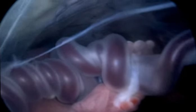 Những ca mổ đặc biệt giành giật sinh mệnh cho bệnh nhân... chưa chào đời - 4