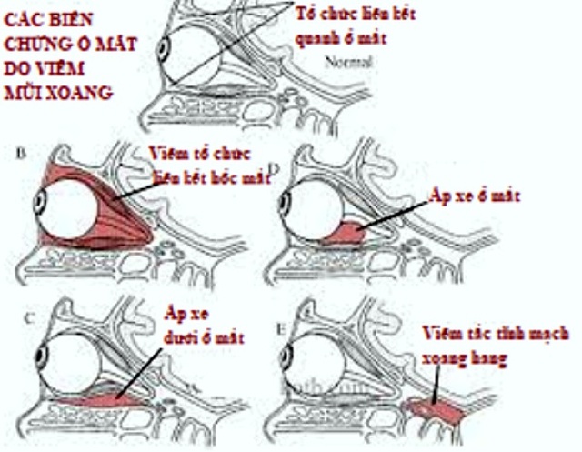 Viêm mũi xoang: Coi chừng biến chứng nguy hiểm khi thời tiết đổi mùa - 2 Viêm mũi xoang: Coi chừng biến chứng nguy hiểm khi thời tiết đổi mùa - 2