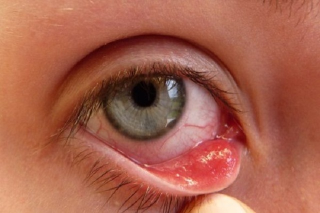 Cảnh báo bệnh lý về mắt thường bùng phát 10 ngày sau lũ - 3