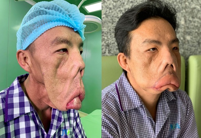 Người mang “gương mặt quỷ” mắc căn bệnh cực hiếm - 3 Người mang “gương mặt quỷ” mắc căn bệnh cực hiếm - 3
