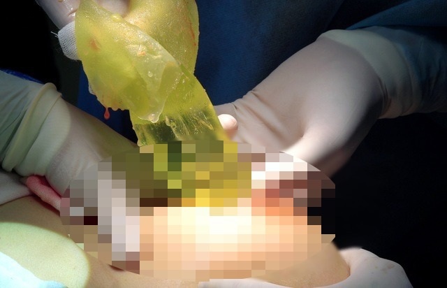 Đặt túi ngực có làm tăng nguy cơ bị ung thư vú? - 2 Đặt túi ngực có làm tăng nguy cơ bị ung thư vú? - 2