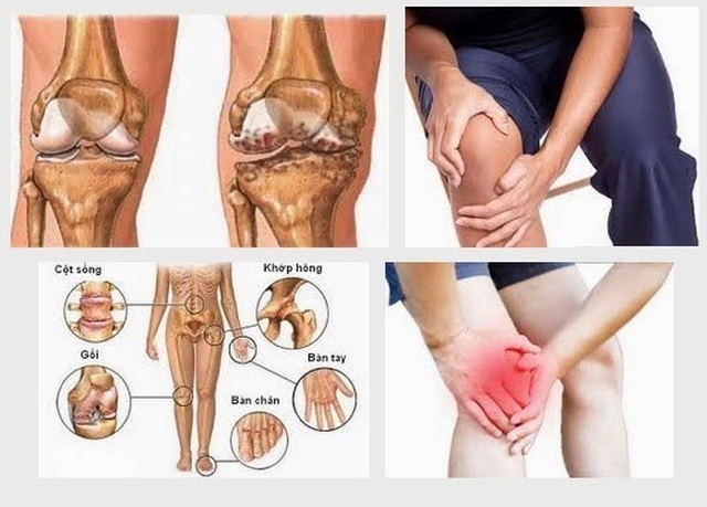 Hiệu quả tuyệt vời khi tiêm tế bào gốc điều trị thoái hóa khớp - 1 Hiệu quả tuyệt vời khi tiêm tế bào gốc điều trị thoái hóa khớp - 1