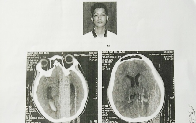 Vụ nam sinh bị đánh chấn thương não: Công an lý giải nguyên nhân chậm trễ - 1 Vụ nam sinh bị đánh chấn thương não: Công an lý giải nguyên nhân chậm trễ - 1