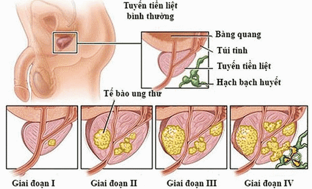 Ung thư tuyến tiền liệt không còn đáng sợ? - 1 Ung thư tuyến tiền liệt không còn đáng sợ? - 1