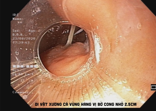2 chiếc xương cá cùng đâm vào dạ dày - 1 2 chiếc xương cá cùng đâm vào dạ dày - 1