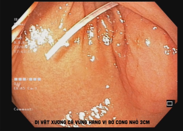 2 chiếc xương cá cùng đâm vào dạ dày - 2 2 chiếc xương cá cùng đâm vào dạ dày - 2