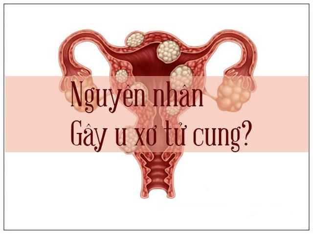 Nguyên nhân gây u xơ tử cung và cách phòng ngừa, cải thiện hiệu quả nhờ Nga Phụ Khang - 1 Nguyên nhân gây u xơ tử cung và cách phòng ngừa, cải thiện hiệu quả nhờ Nga Phụ Khang - 1