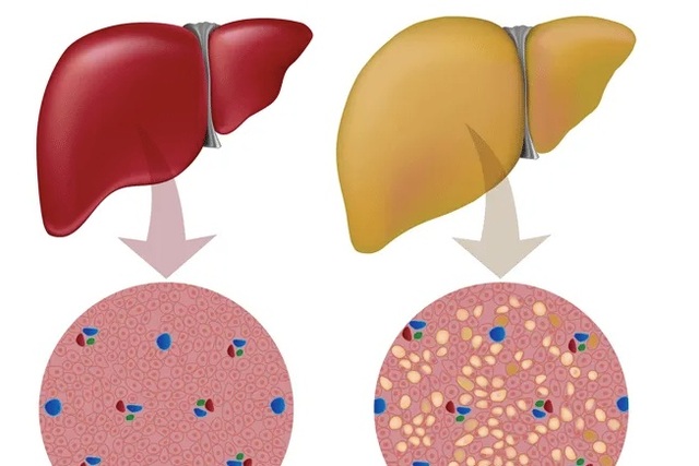 Không có triệu chứng, gan nhiễm mỡ “âm thầm” tiến triển viêm gan, xơ gan - 1