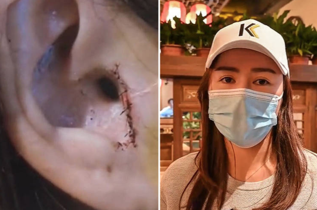 Bàng hoàng vì mất tai sau phẫu thuật sửa… mũi - 1 Bàng hoàng vì mất tai sau phẫu thuật sửa… mũi - 1