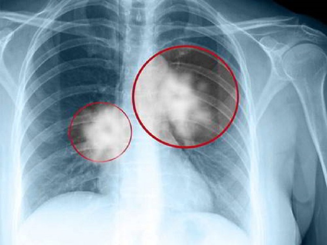 Hiểu biết mới về ung thư phổi tạo đột phá trong điều trị - 1