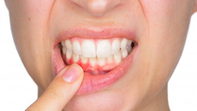 Ung thư đường tiêu hóa rình rập chỉ vì lười... đánh răng - 1 Ung thư đường tiêu hóa rình rập chỉ vì lười... đánh răng - 1