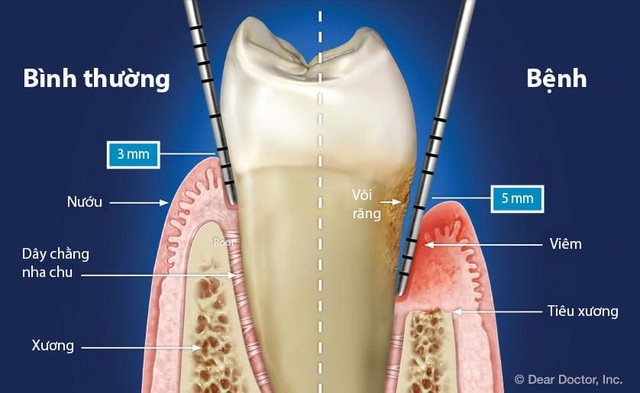Men vi sinh nha khoa - Giải pháp mới cho bệnh viêm nha chu - 1 Men vi sinh nha khoa - Giải pháp mới cho bệnh viêm nha chu - 1