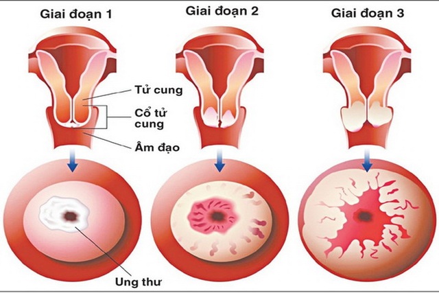 HPV gây ra ung thư gì? - 1 HPV gây ra ung thư gì? - 1