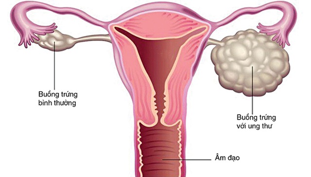 Diễn tiến và triệu chứng của ung thư buồng trứng - 1