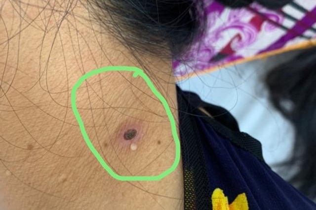 Người phụ nữ bị suy gan, hôn mê chỉ vì một vết đốt ở cổ - 1 Người phụ nữ bị suy gan, hôn mê chỉ vì một vết đốt ở cổ - 1