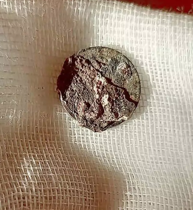 Người đàn ông mắc kẹt đồng xu trong mũi suốt 50 năm - 3 Người đàn ông mắc kẹt đồng xu trong mũi suốt 50 năm - 3
