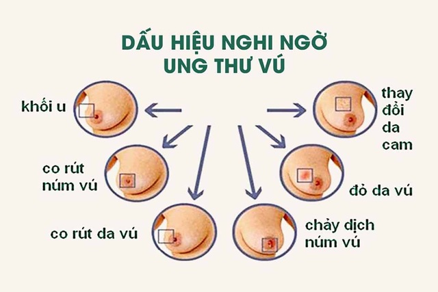 Phụ nữ có một trong các yếu tố này dễ mắc ung thư vú - 2