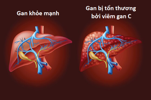 Những thói quen xấu khiến viêm gan nhanh chóng tiến triển thành xơ gan - 3 Những thói quen xấu khiến viêm gan nhanh chóng tiến triển thành xơ gan - 3