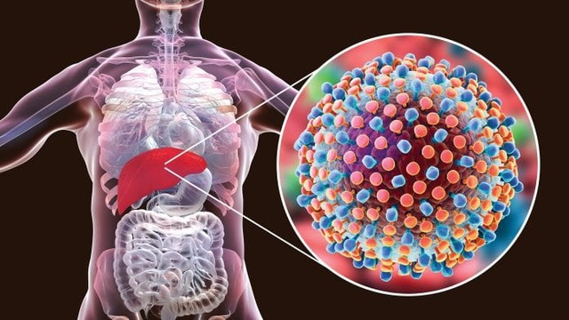 Những thói quen xấu khiến viêm gan nhanh chóng tiến triển thành xơ gan |  Báo Dân trí