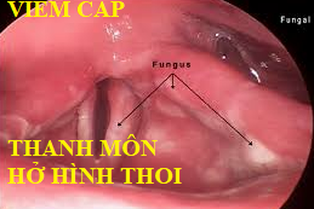 Xử trí như thế nào khi bị khàn tiếng vào mùa lạnh - 1