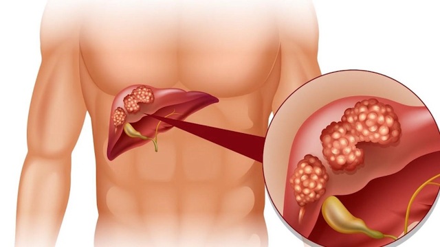 4 bệnh gan nguy hiểm chỉ vì thức uống khoái khẩu của nhiều đấng mày râu - 2 4 bệnh gan nguy hiểm chỉ vì thức uống khoái khẩu của nhiều đấng mày râu - 2