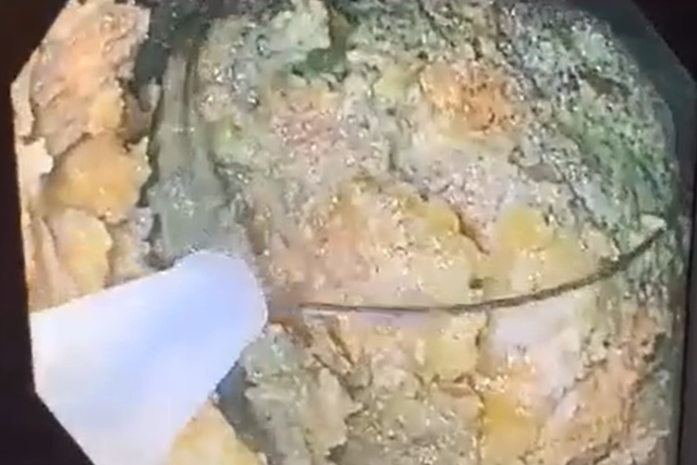 Ăn 5 quả hồng ngâm, người phụ nữ suýt tắc ruột vì khối bã to hơn nắm tay - 1 Ăn 5 quả hồng ngâm, người phụ nữ suýt tắc ruột vì khối bã to hơn nắm tay - 1