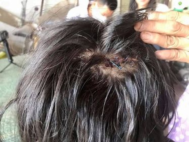 Nữ sinh bị đánh sau tai nạn: Phải khâu 10 mũi trên đầu, chấn thương mặt - 2 Nữ sinh bị đánh sau tai nạn: Phải khâu 10 mũi trên đầu, chấn thương mặt - 2