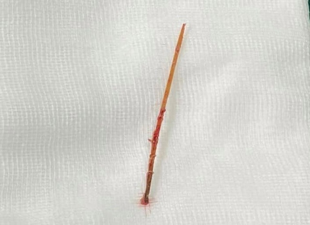 Cụ ông nuốt nhầm tăm bị đâm thủng đường tiêu hóa xuyên đến gan - 2 Cụ ông nuốt nhầm tăm bị đâm thủng đường tiêu hóa xuyên đến gan - 2