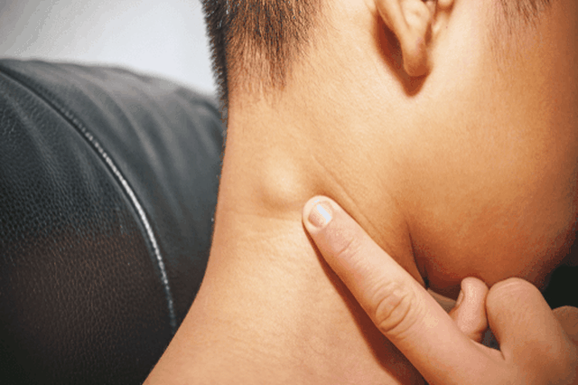 Sốt, vã mồ hôi về đêm- dấu hiệu cảnh báo u lympho ác tính không Hodgkin - 1 Sốt, vã mồ hôi về đêm- dấu hiệu cảnh báo u lympho ác tính không Hodgkin - 1