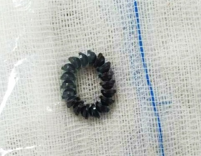 18 viên nam châm xếp hình trong ruột bé trai 3 tuổi - 3 18 viên nam châm xếp hình trong ruột bé trai 3 tuổi - 3