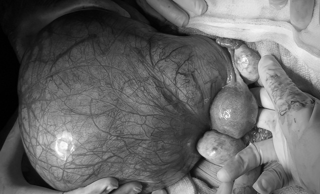Sau chích nội tiết tố chuyển giới, nữ bệnh nhân thấy bụng lớn dần - 1 Sau chích nội tiết tố chuyển giới, nữ bệnh nhân thấy bụng lớn dần - 1