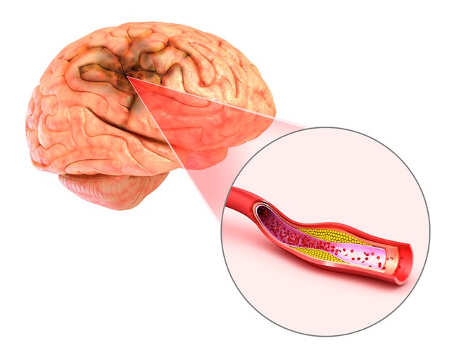 Đột quỵ não và vai trò của chụp cộng hưởng từ (MRI) trong tầm soát đột quỵ - 1 Đột quỵ não và vai trò của chụp cộng hưởng từ (MRI) trong tầm soát đột quỵ - 1