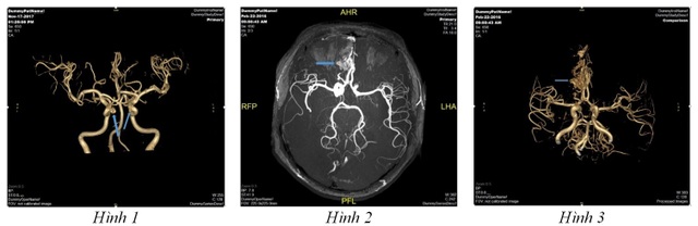 Đột quỵ não và vai trò của chụp cộng hưởng từ (MRI) trong tầm soát đột quỵ - 2 Đột quỵ não và vai trò của chụp cộng hưởng từ (MRI) trong tầm soát đột quỵ - 2