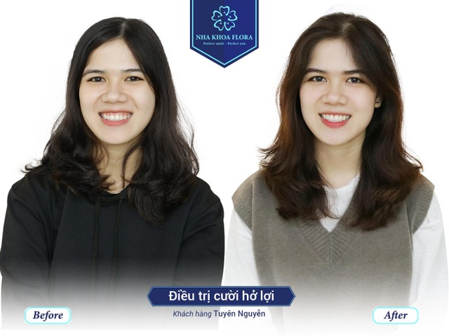 3 cách cười không hở lợi mới nhất bạn nên biết - 2 3 cách cười không hở lợi mới nhất bạn nên biết - 2