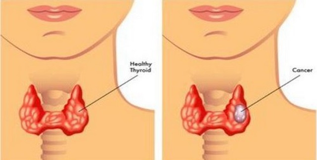 Ung thư vòm họng: Dấu hiệu nhận biết sớm và cách điều trị - 1