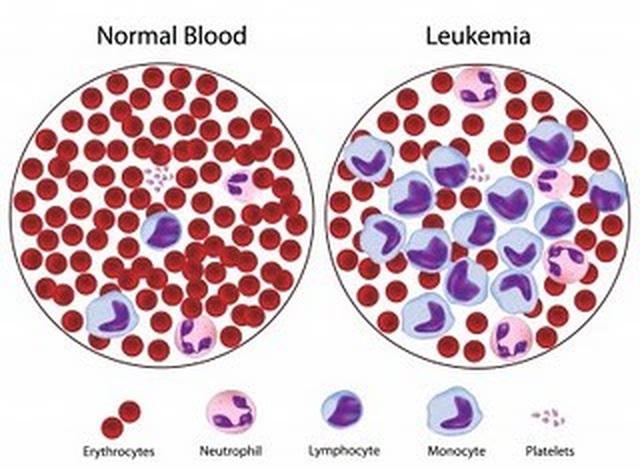 Dấu hiệu sớm của ung thư máu mạn tính - 1