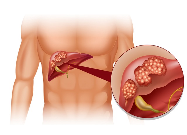 5 thủ phạm làm tăng nguy cơ mắc ung thư gan ít được biết đến - 1