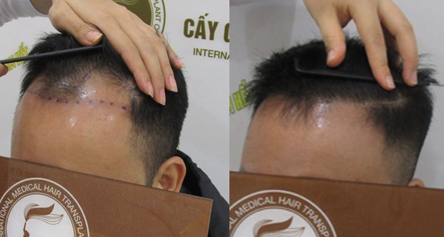 Cơ hội cấy tóc miễn phí tại Hà Nội và TP. HCM - 2 Cơ hội cấy tóc miễn phí tại Hà Nội và TP. HCM - 2