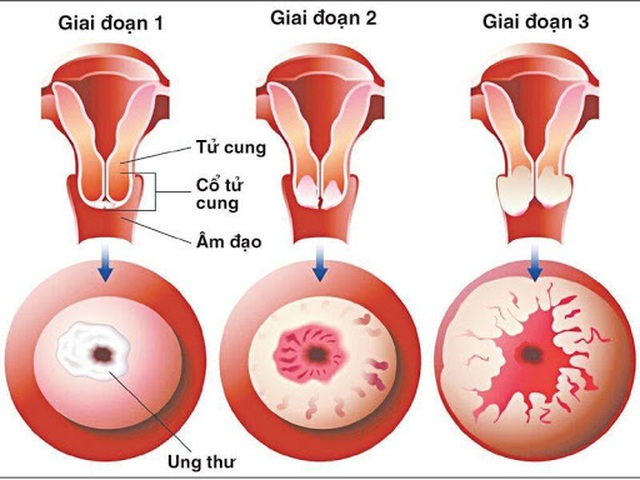 Biện pháp quan trọng nhất phòng lây nhiễm HPV- virus gây ung thư cổ tử cung - 2